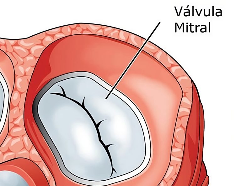 Insuficiencia mitral